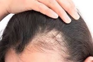 همه چیز در مورد کاشت مو 300x200 - همه چیز در مورد کاشت مو